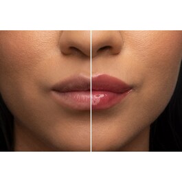 Lip Injection - Dudak balmı