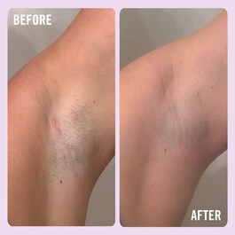 Ingrown Hair Pads - BHA & AHA Batık Saç Tedavisi