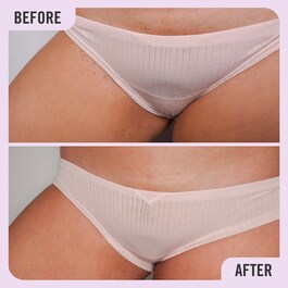 Ingrown Hair Pads - BHA & AHA Batık Saç Tedavisi