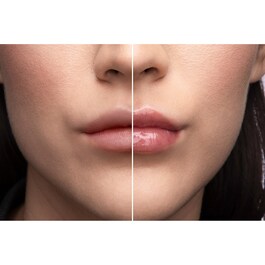 Lip Injection - Dudak balmı