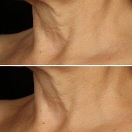 Smart Clinical Repair - Lifting Etkili Yüz ve Boyun Kremi