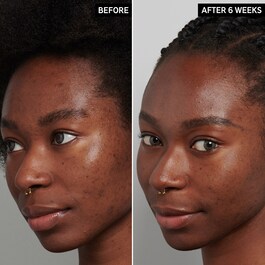 Tranexamic Acid Hyperpigmentation Night Treatment - Cilt Eşitleyici Gece Bakımı