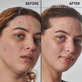 Dry and rough skin slution with 10% urea - Yüz  Serumu