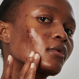 Excess oil solution with 20% niacinamide - Yüz Serumu