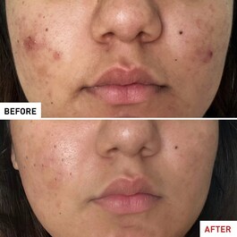 Centella Acné Care - Yatıştırıcı Sıvı