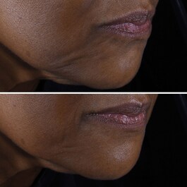 Smart Clinical Repair - Lifting Etkili Yüz ve Boyun Kremi