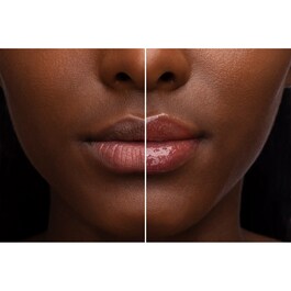 Lip Injection - Dudak balmı