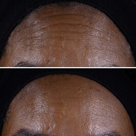 Smart Clinical Repair - Lifting Etkili Yüz ve Boyun Kremi