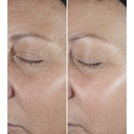 Smart Clinical Repair™ - Kırışıklık Karşıtı Düzeltici Serum